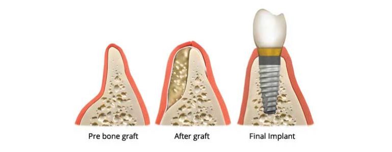 Dental Bone Grafting Bronx NY - Your Bronx Dentist