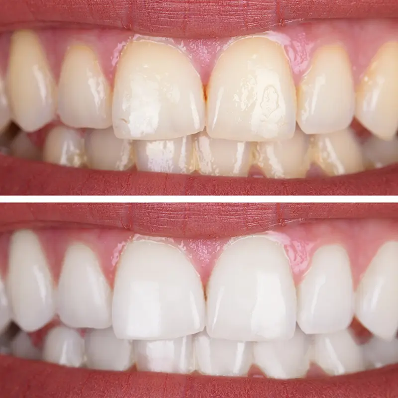 Teeth Whitening Before & After